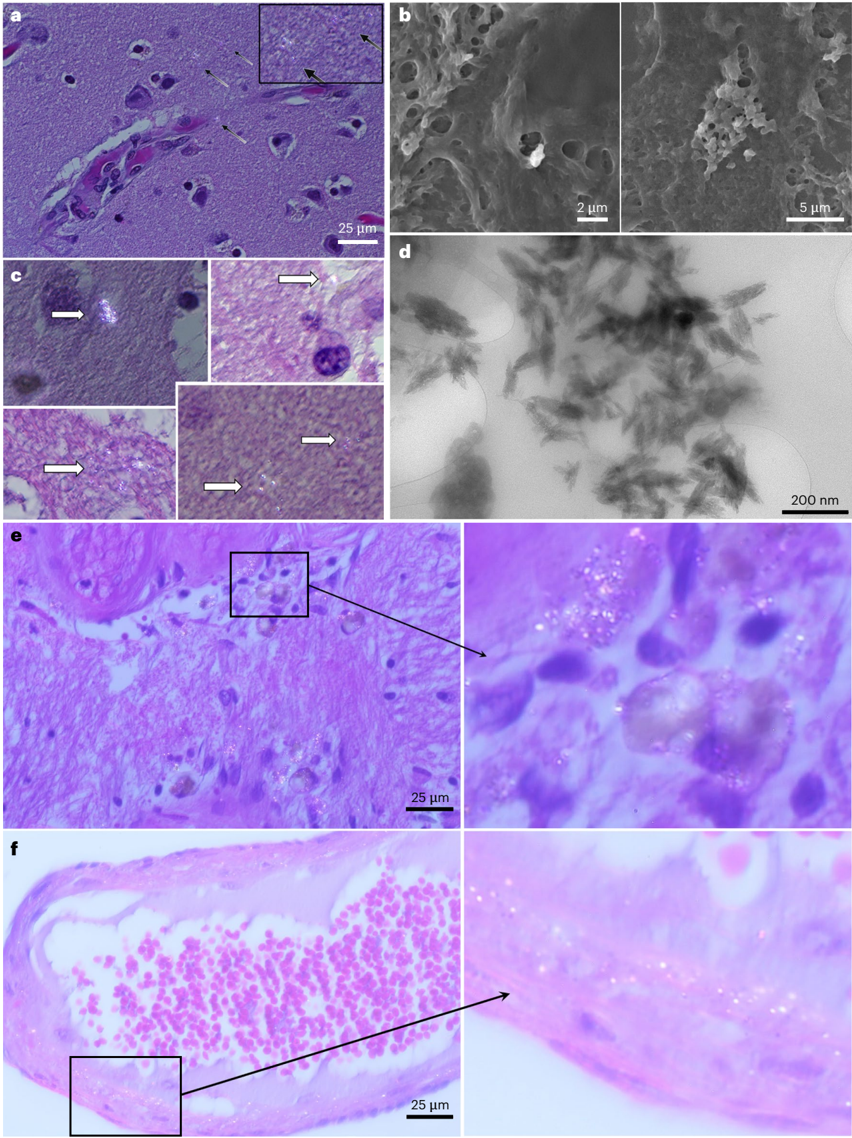 Figure 2: Polarization wave microscopy, SEM, and TEM images showing nanoplastic particles in brain tissue, with dementia samples showing greater inflammatory deposition